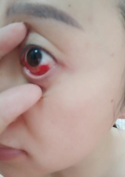 眼球充血是怎么回事（洗澡白眼球充血是怎么回事）