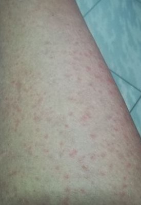 皮肤起红疹（皮肤起红疹不痛不痒）