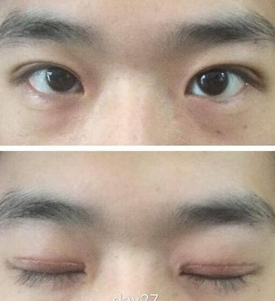 男士割双眼皮(男性双眼皮整形愈发普遍)