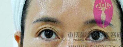 超声法去眼袋大概多少钱（超声法去眼袋可不可靠）