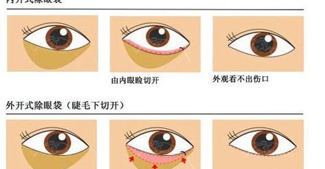 包含不要手术去眼袋的词条