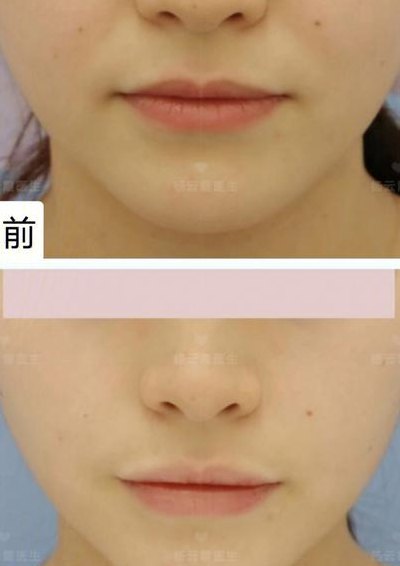 面部吸脂恢复（面部吸脂恢复记录）