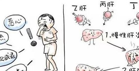 丙肝炎的早期症状（丙肝炎病症状有哪些）