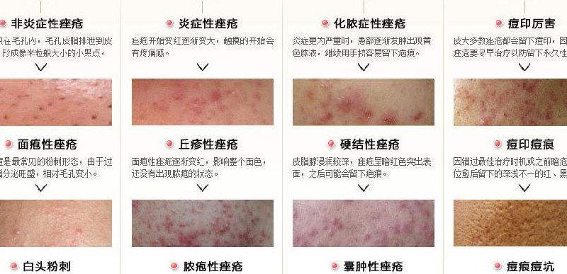 治疗痤疮最好的方法(治疗痤疮的最佳方法)