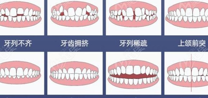 纠正牙齿需要多少钱（纠正牙齿需要多少钱一颗）