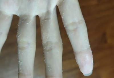 手掌脱皮怎么办（手掌脱皮怎么办教你三招轻松搞定）