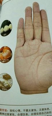 手纹看病（手纹看病专家）