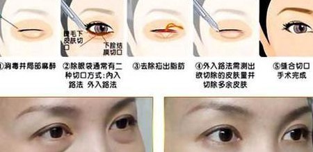 吸脂术去眼袋（吸脂术去眼袋多少钱）
