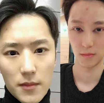 男生割双眼皮（男生割双眼皮正常吗）