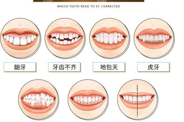矫正龅牙（矫正龅牙需要多少钱）