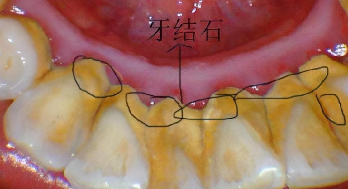 牙结石怎么办（牙齿里有牙结石怎么办）