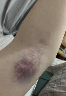 皮肤瘀青（皮肤瘀青是怎么回事）