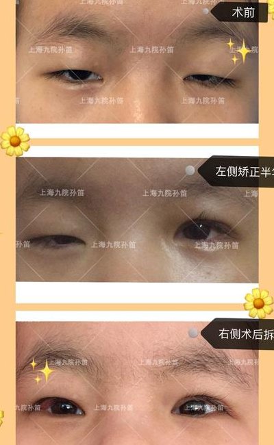 上睑下垂矫正手术一般多少钱（上睑下垂矫正术后图片）