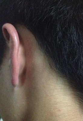 耳后淋巴结肿大图片(耳部淋巴结肿胀的图像)