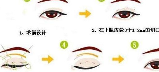 三点定位（三点定位双眼皮能维持多久）