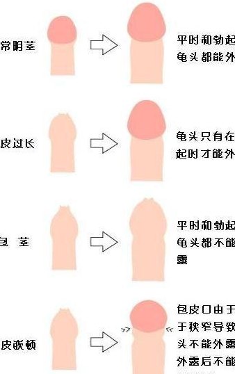 包皮过长是什么样图片（包皮过长的图片标准）