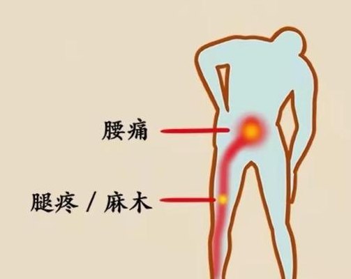 肾疼和腰疼的区别图（腰疼）