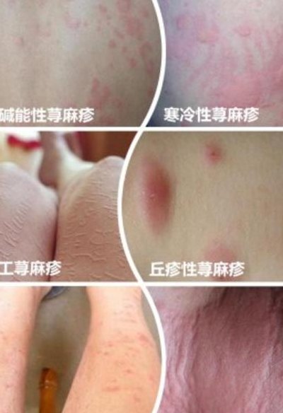 荨麻疹辨别图片（荨麻疹怎么分辨是哪种）