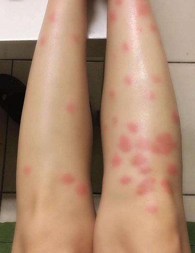 跳蚤咬过后的疙瘩照片（跳蚤咬过后的疙瘩照片留疤）