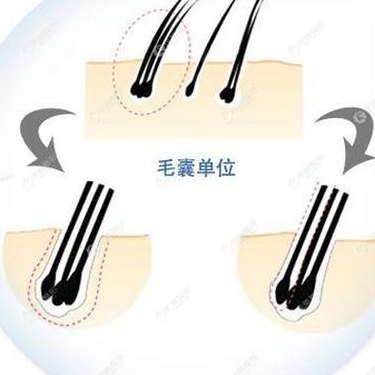 种植头发多少钱（种植头发多少钱一个毛囊）