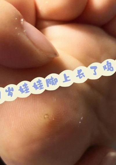 肉刺怎么去除（手指上长肉刺怎么去除）