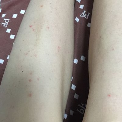 腿上有小红点图片（腿上有小红点图片症状不痛不痒）