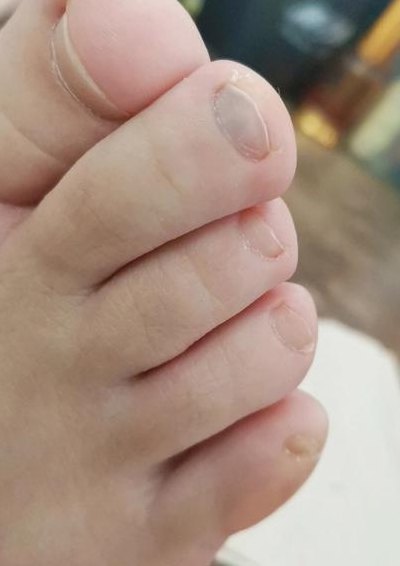 脚趾甲发黑（脚趾甲发黑怎么回事）