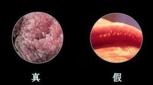 尖锐湿疣照片（男性湿锐尖疣治疗方法）