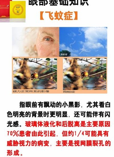 飞蚊症怎么治疗恢复（飞蚊症怎么治疗恢复吃什么）