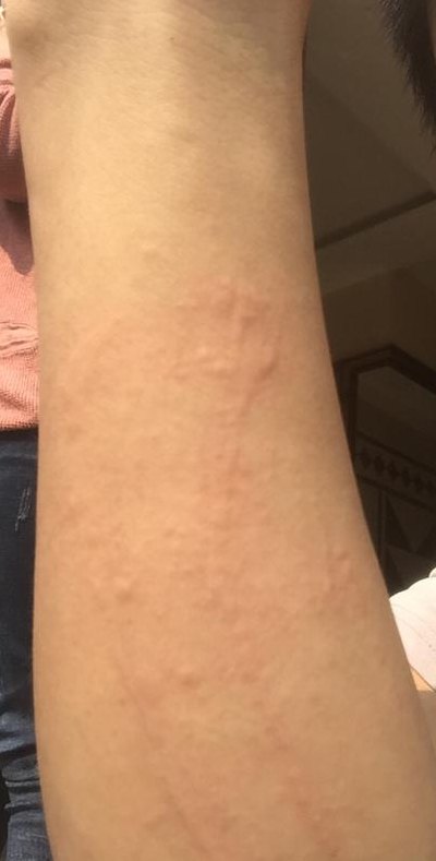 蟑螂爬后皮肤过敏图片（拍一拍识别皮肤病）