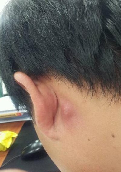 耳下淋巴结肿大图片（耳下淋巴结肿大图片 位置图）