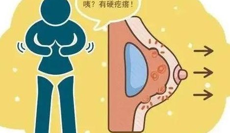 乳腺癌中期（乳腺癌中期扩散到腋下淋巴能活多久）