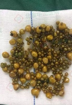 结石的症状有哪些（胆囊结石的症状有哪些）