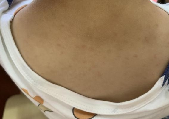身上起小红点图片（孩子身上起小红点图片）