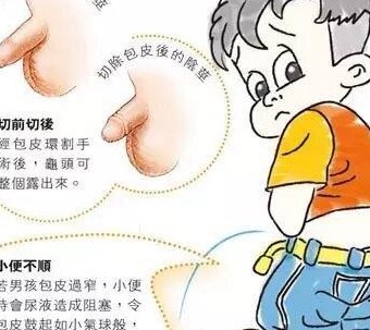 小孩包皮过长图片（小孩包皮过长图片长治泌尿专科在哪）