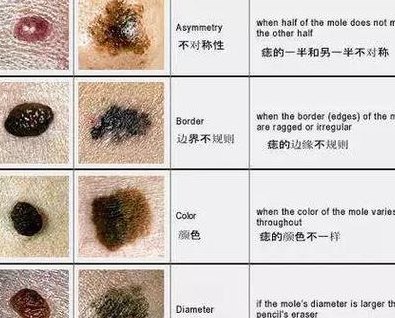 哪种黑斑是癌变图片（哪种黑斑是癌变图片 癌症）