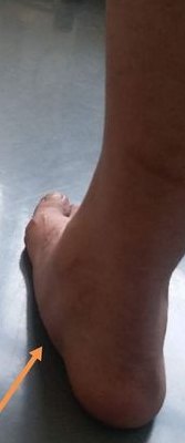 扁平足是什么样的图片（扁平足是什么样子的,求图片）