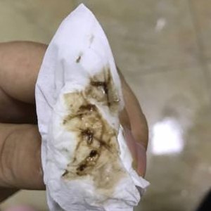 白带是血褐色的图片的简单介绍