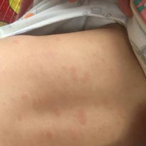 幼儿急疹出的疹子图片（幼儿急疹出的疹子图片是什么）