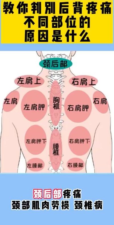 后背疼痛分布图（背部疼痛图解大全）