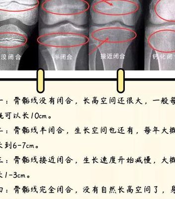 腿短怎么变长（骨骺线怎么看是否闭合）