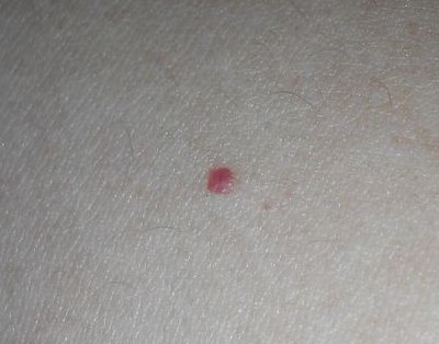 毛细血管小红点图片（像出血点一样的红点）