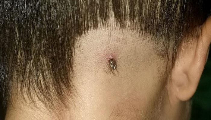 蜱虫叮咬（蜱虫叮咬图片）