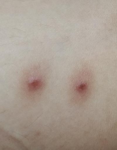 被虱子咬的图片（狗身上的虱子是啥样的图片）