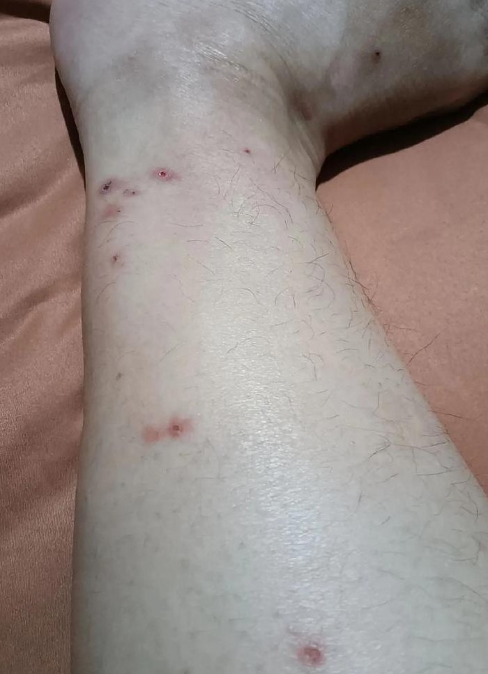 猫虱子咬了的症状（猫虱子叮咬）