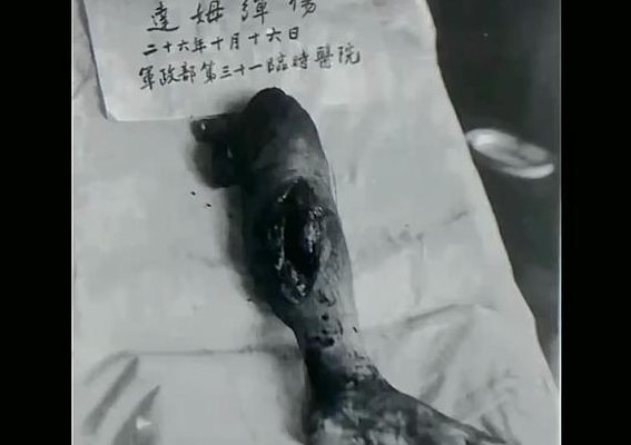 达姆弹伤口图片（达姆弹长什么样子）