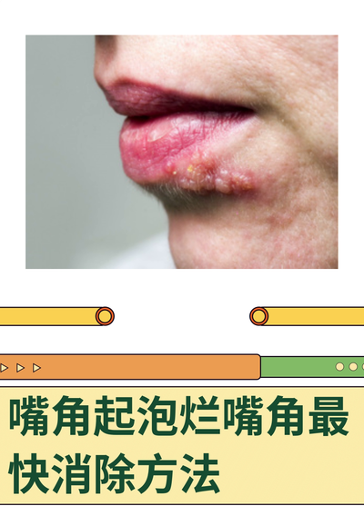 嘴上上火起泡怎么快速消除（嘴上上火起泡怎么快速消除小妙招）
